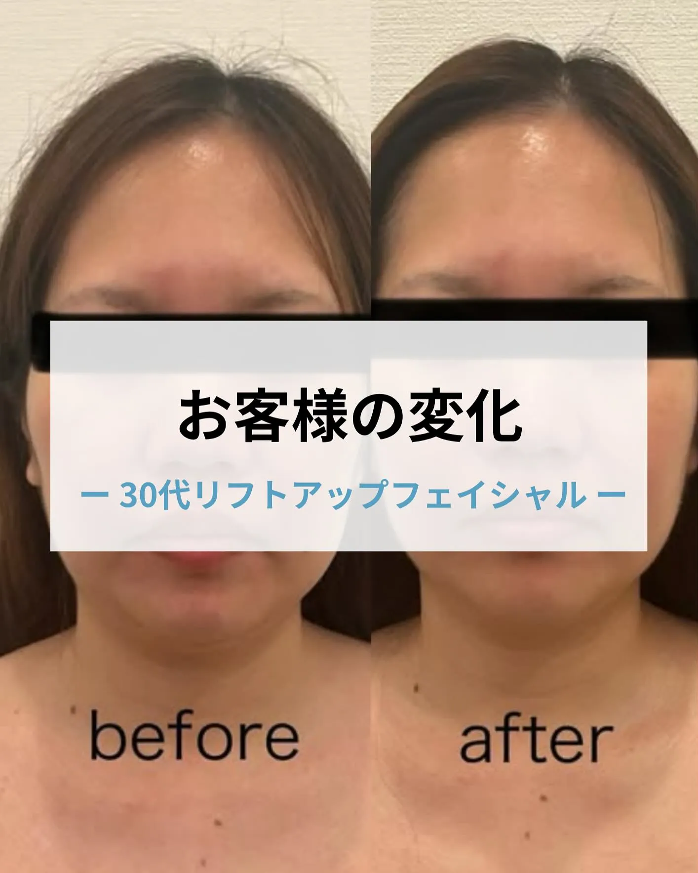 【30代のお客様リフトアップフェイシャルの変化】