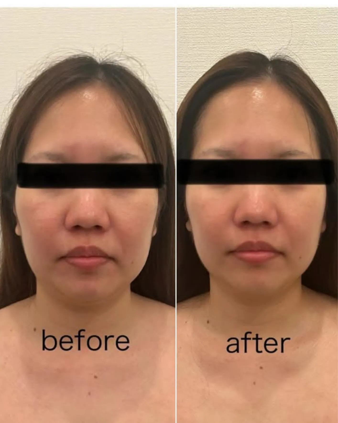【30代のお客様リフトアップフェイシャルの変化】